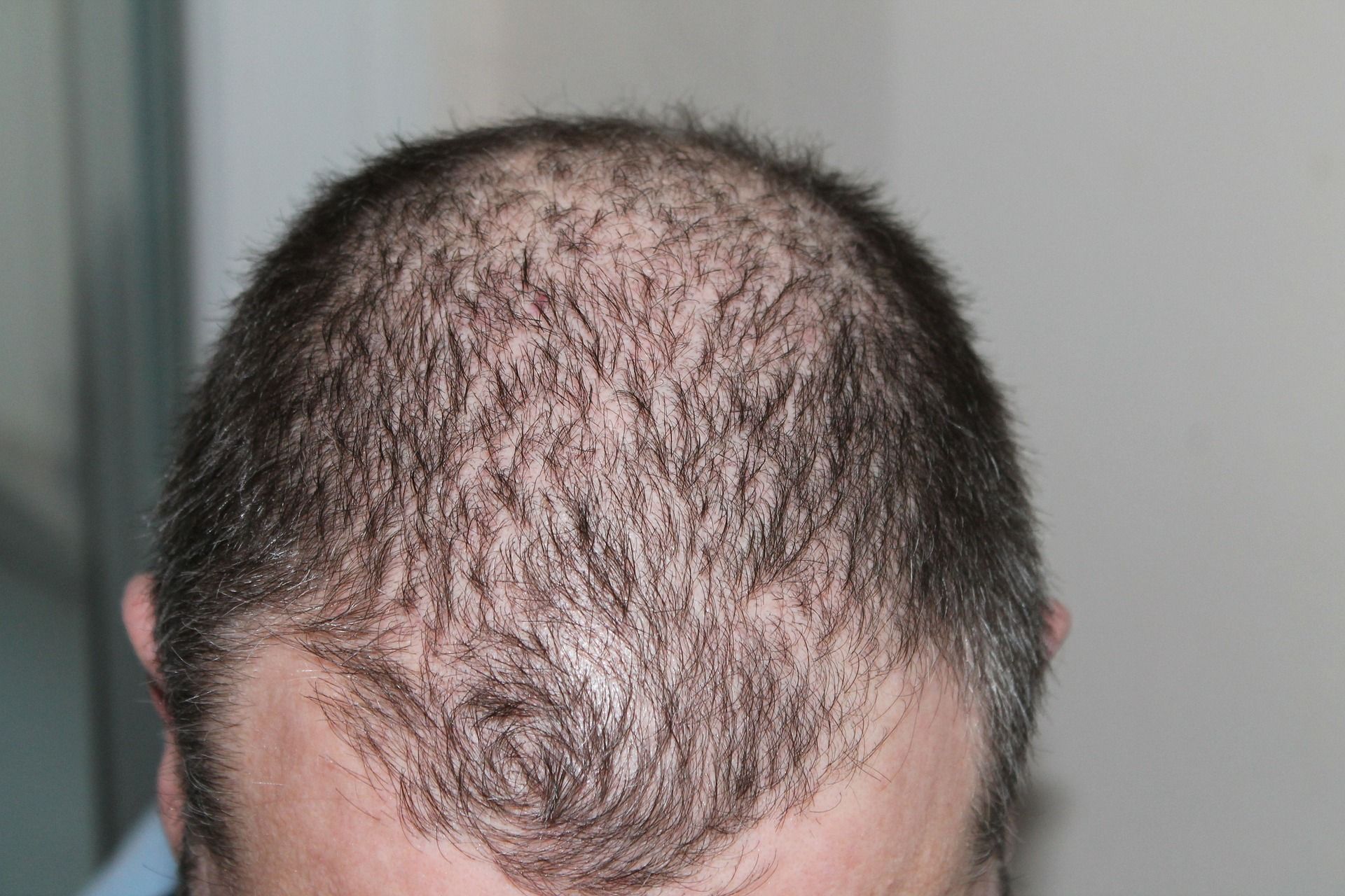 Reviews On iRestore Hair Growth Serum